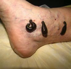 Photograph of leeches on a patient's ankle